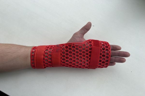 В Свердловском областном госпитале освоили технологии 3D-печати для лечения травм